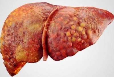 養肝護肝-三樣養肝護肝的好方法:肝受損會引發很多疾病現在急需養肝好方法護肝!