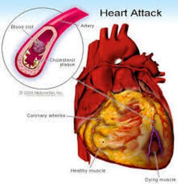 心梗&amp;心肺復甦-心肌梗塞如何自己做急救:心肌梗塞三個簡單步驟救自己一命!